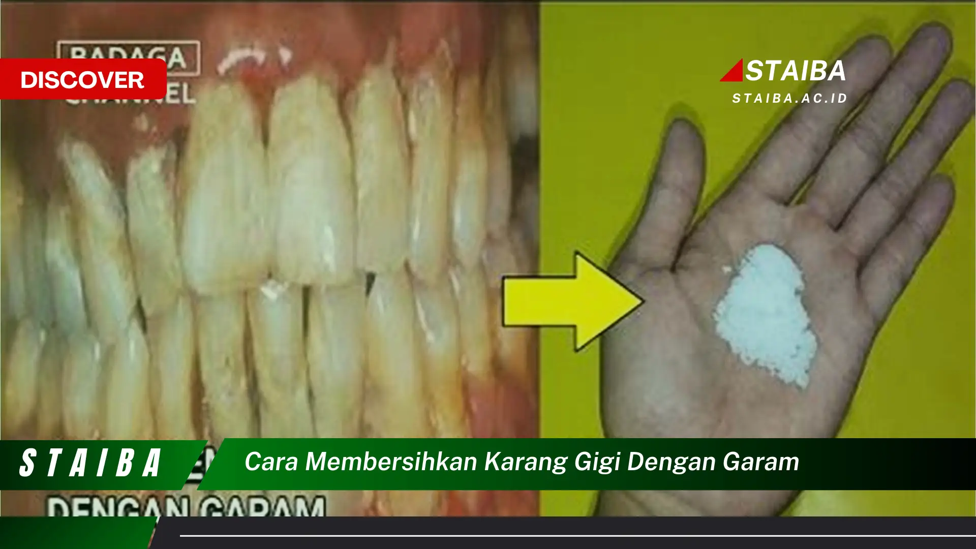 cara membersihkan karang gigi dengan garam