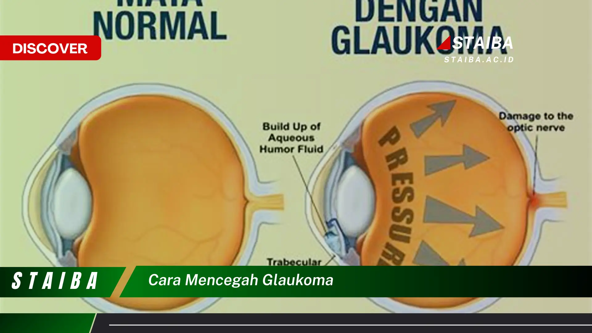 cara mencegah glaukoma