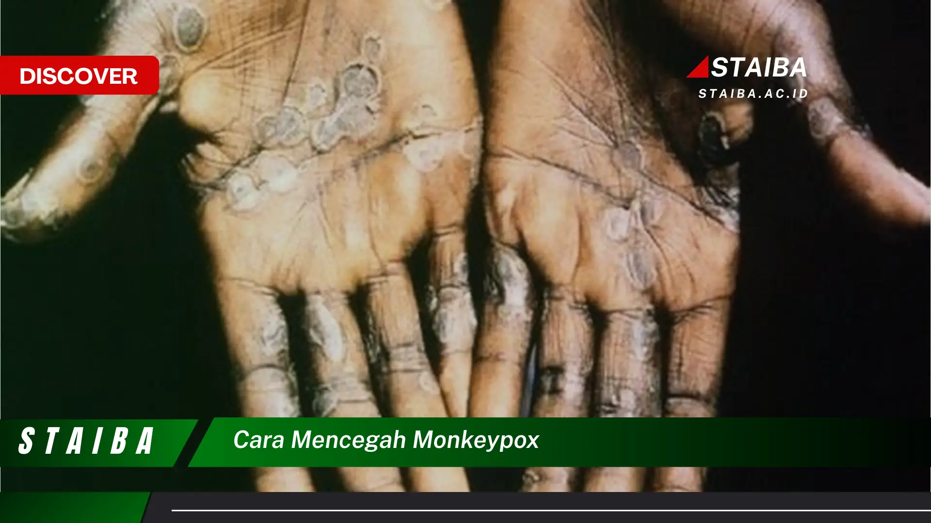 cara mencegah monkeypox