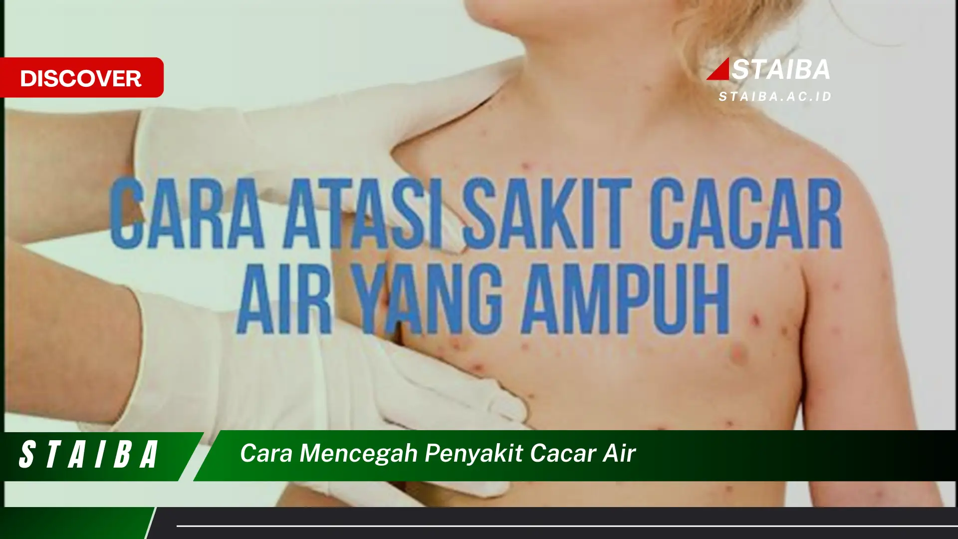 cara mencegah penyakit cacar air