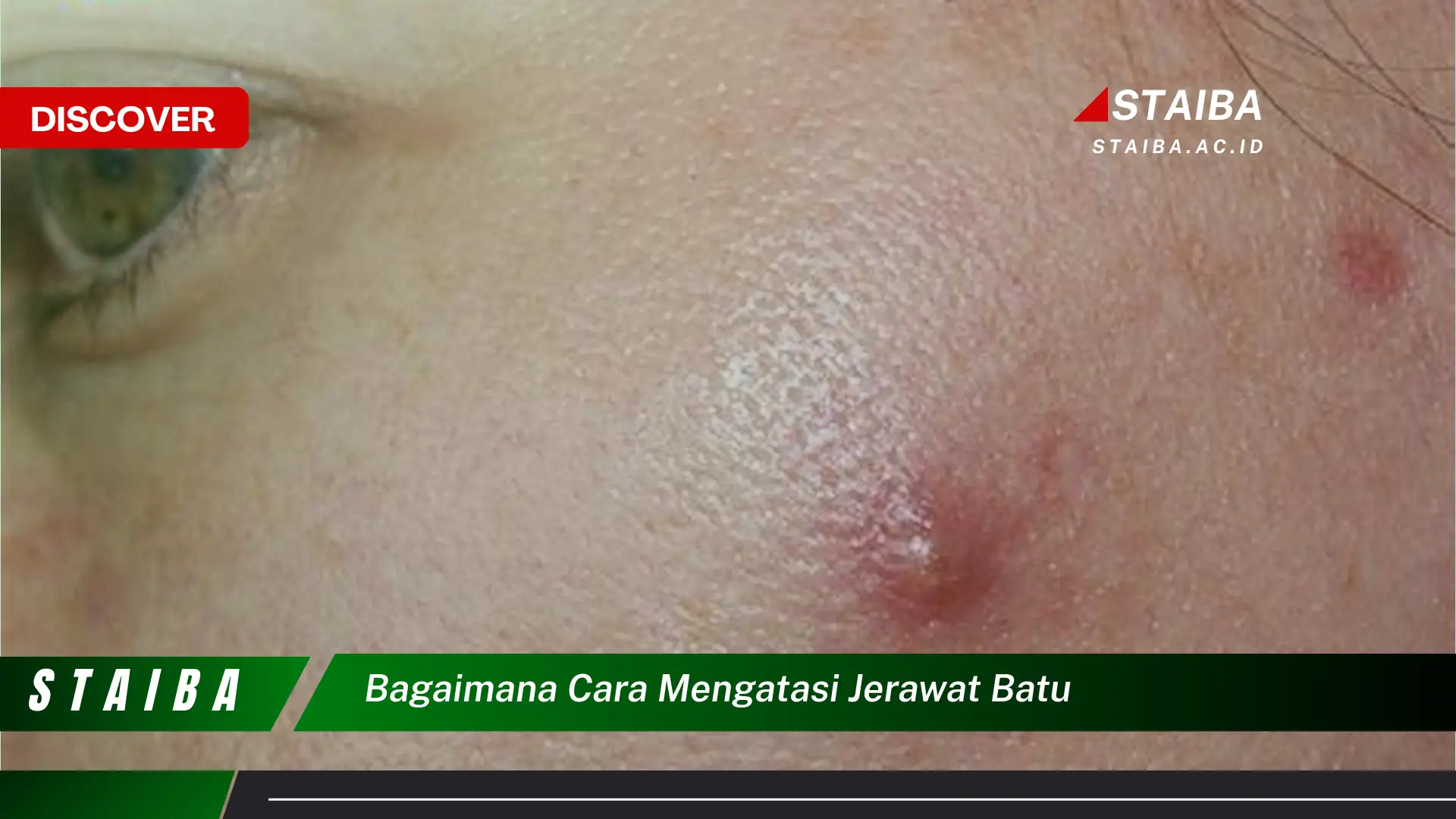 bagaimana cara mengatasi jerawat batu