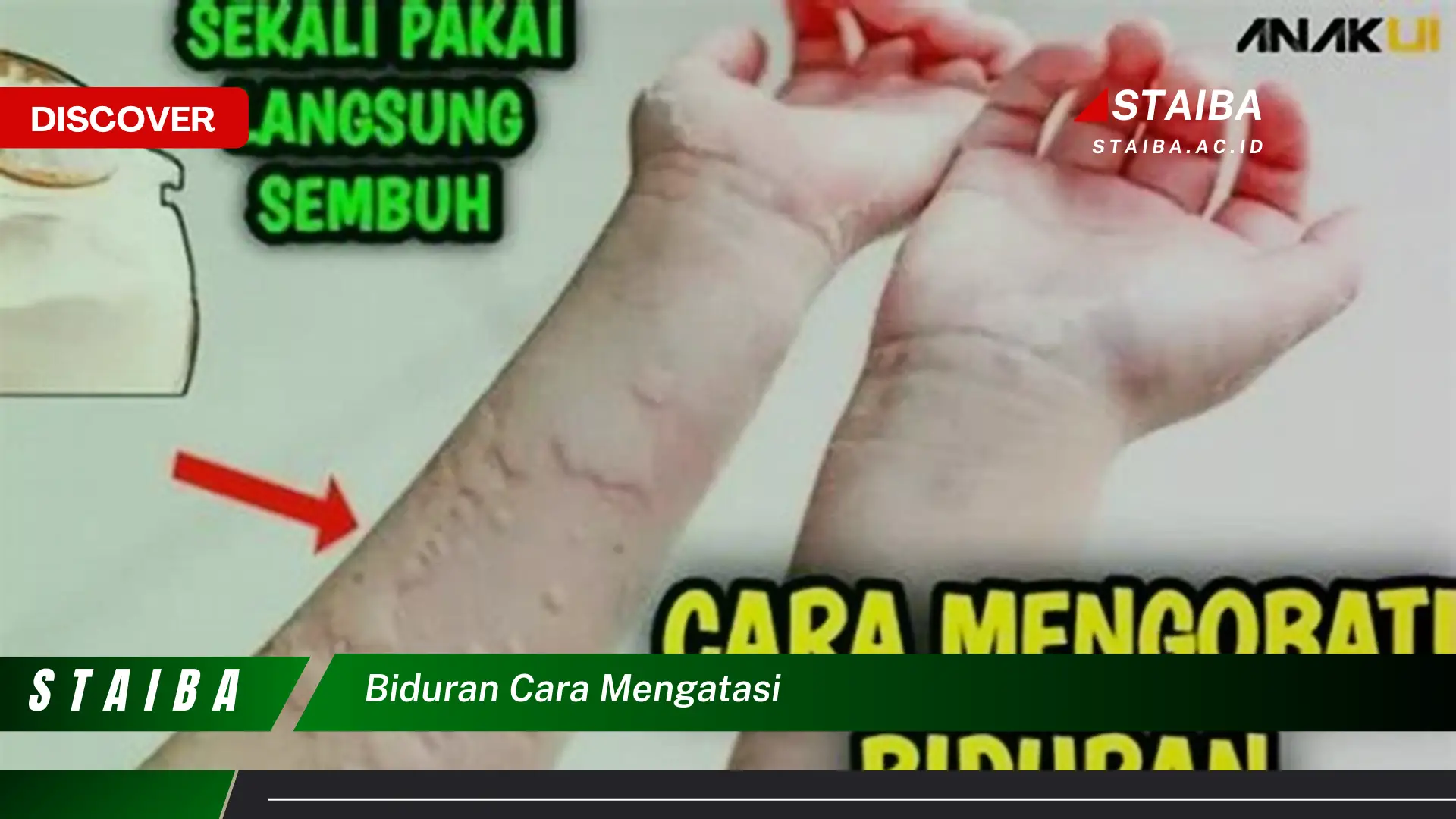 biduran cara mengatasi biduran cara mengatasi