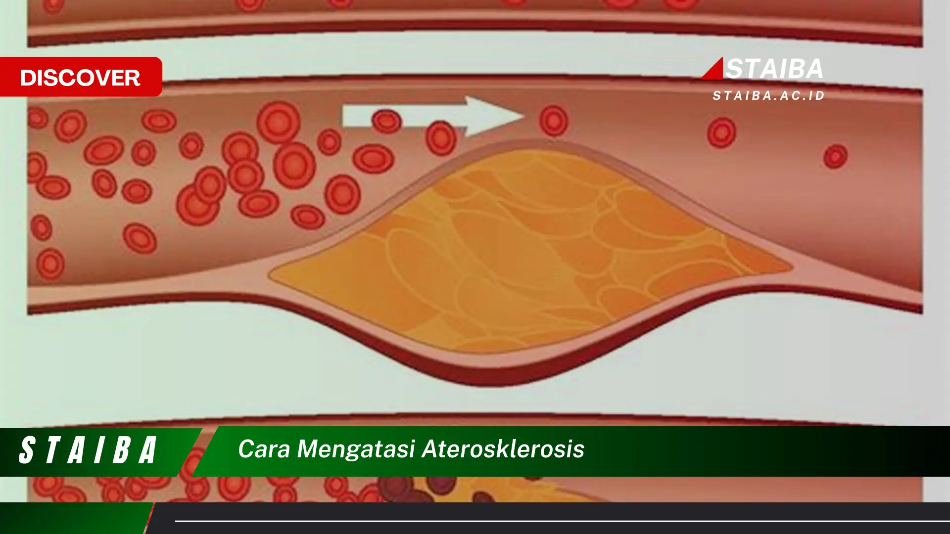 cara mengatasi aterosklerosis