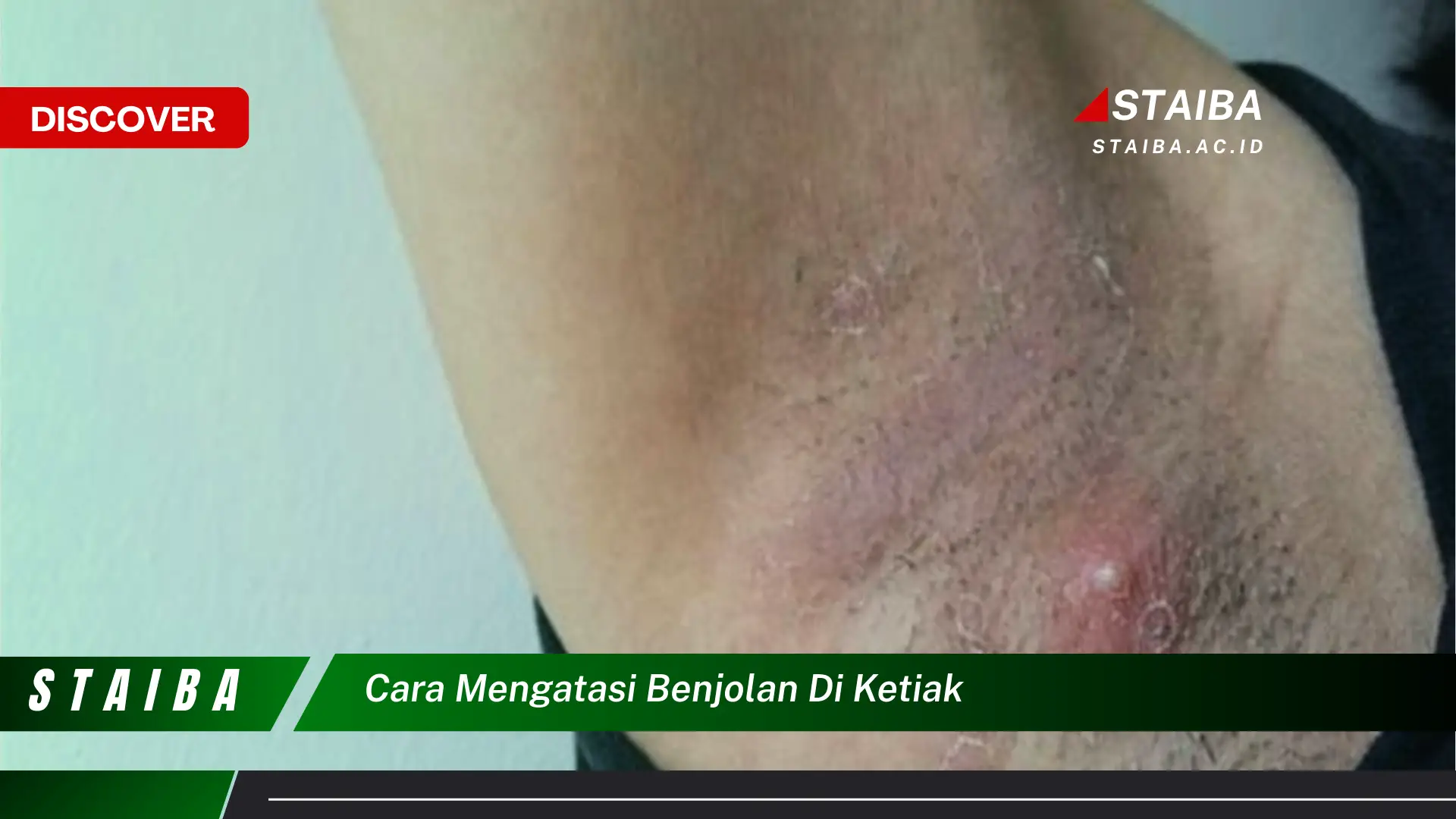 cara mengatasi benjolan di ketiak