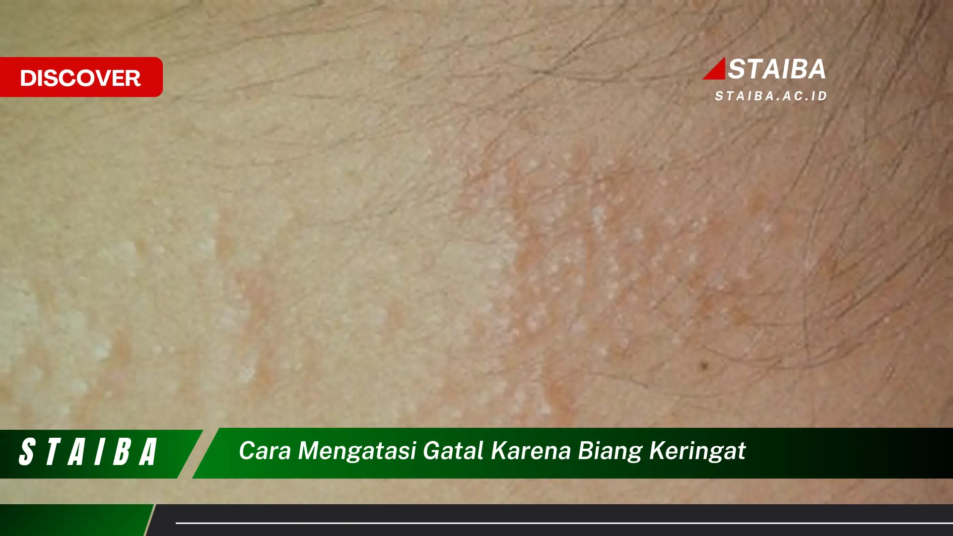 cara mengatasi gatal karena biang keringat