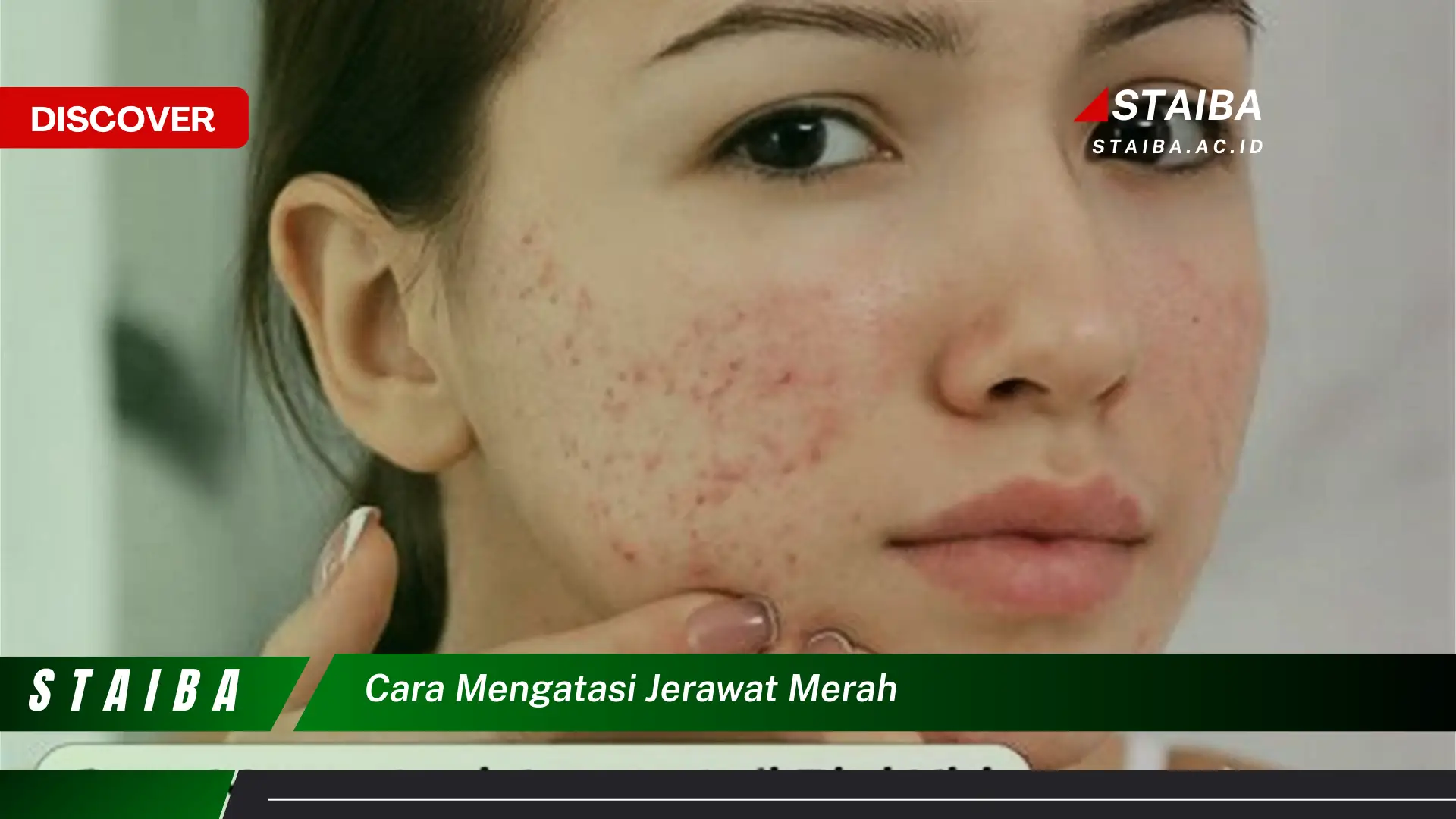 cara mengatasi jerawat merah