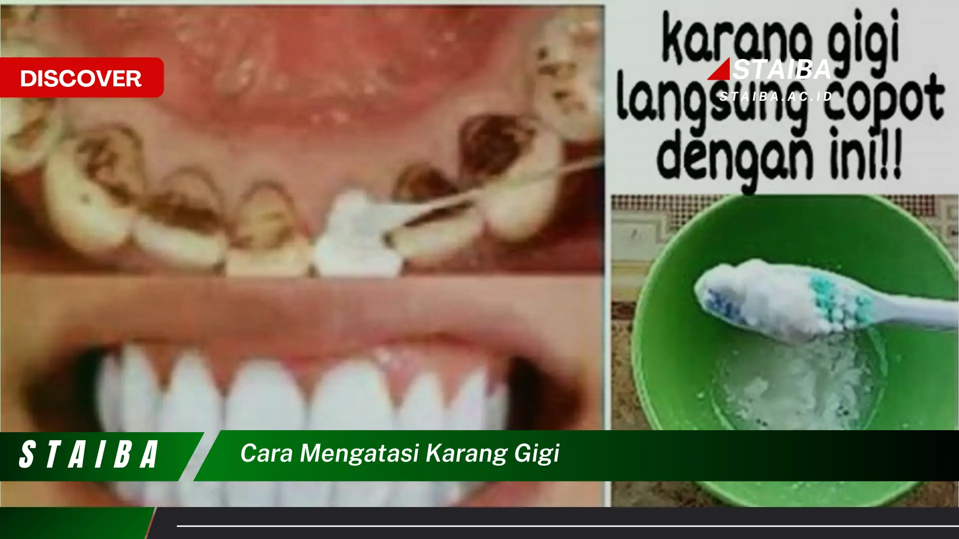 cara mengatasi karang gigi