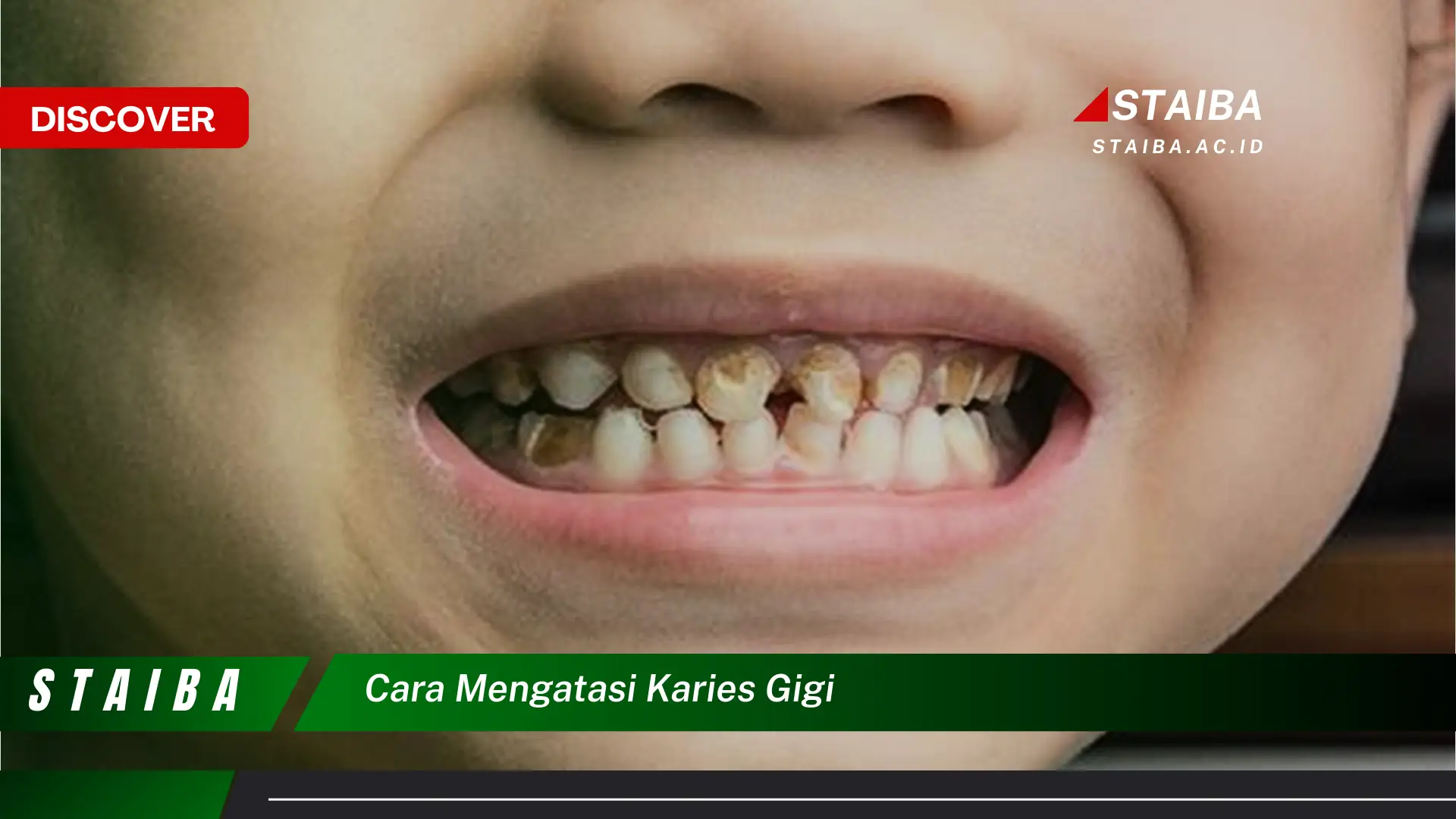 cara mengatasi karies gigi