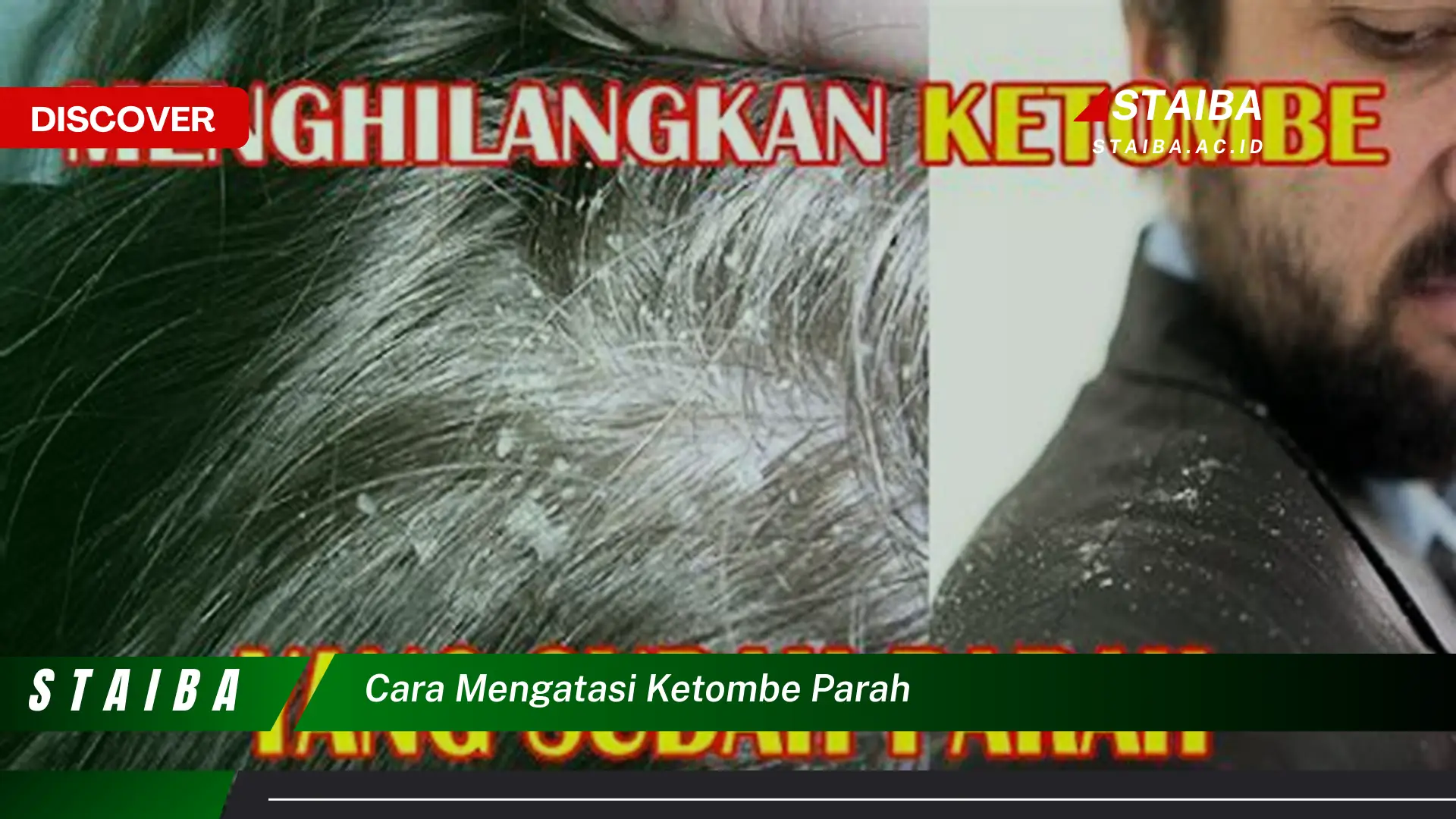 cara mengatasi ketombe parah