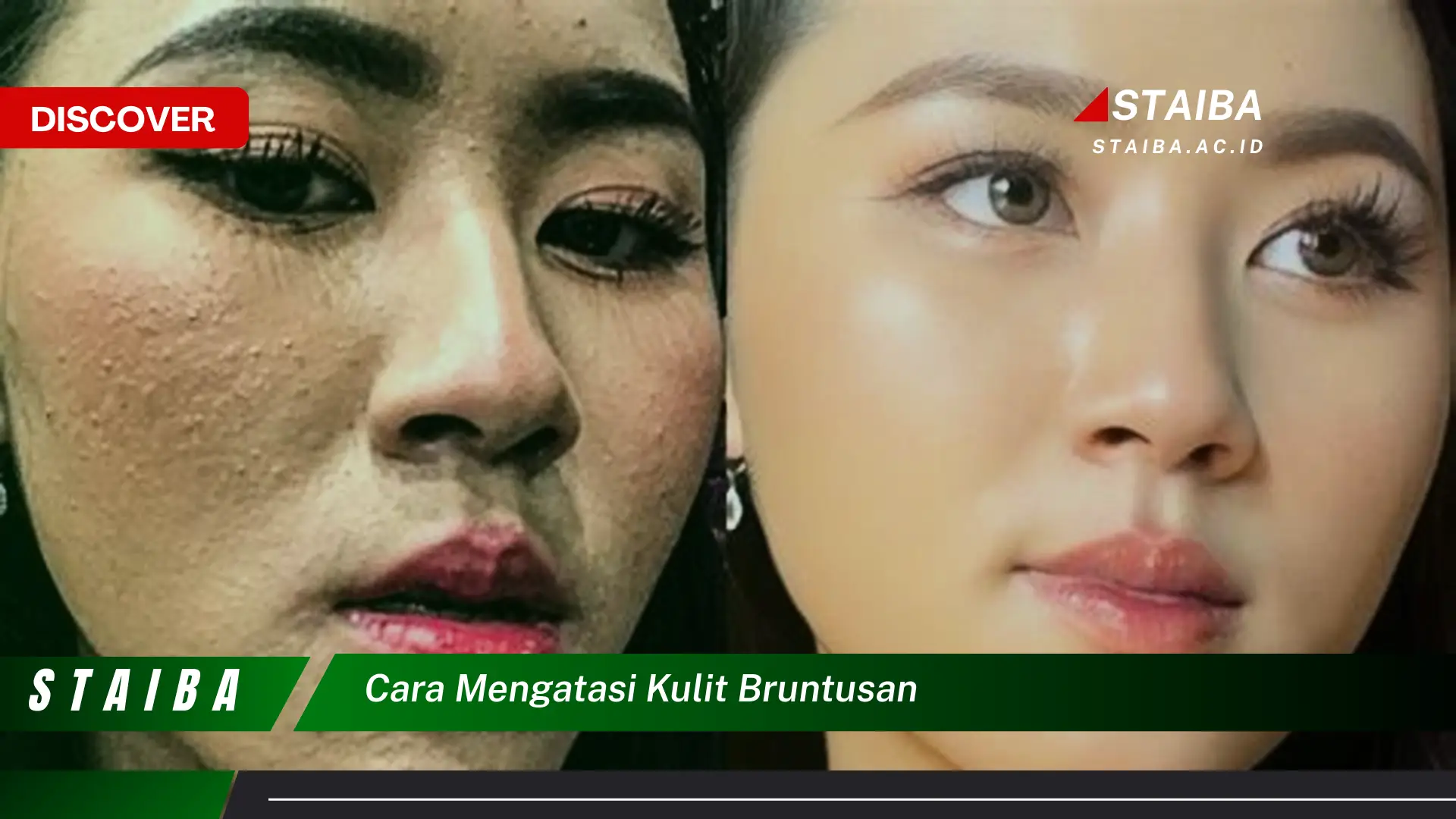 cara mengatasi kulit bruntusan