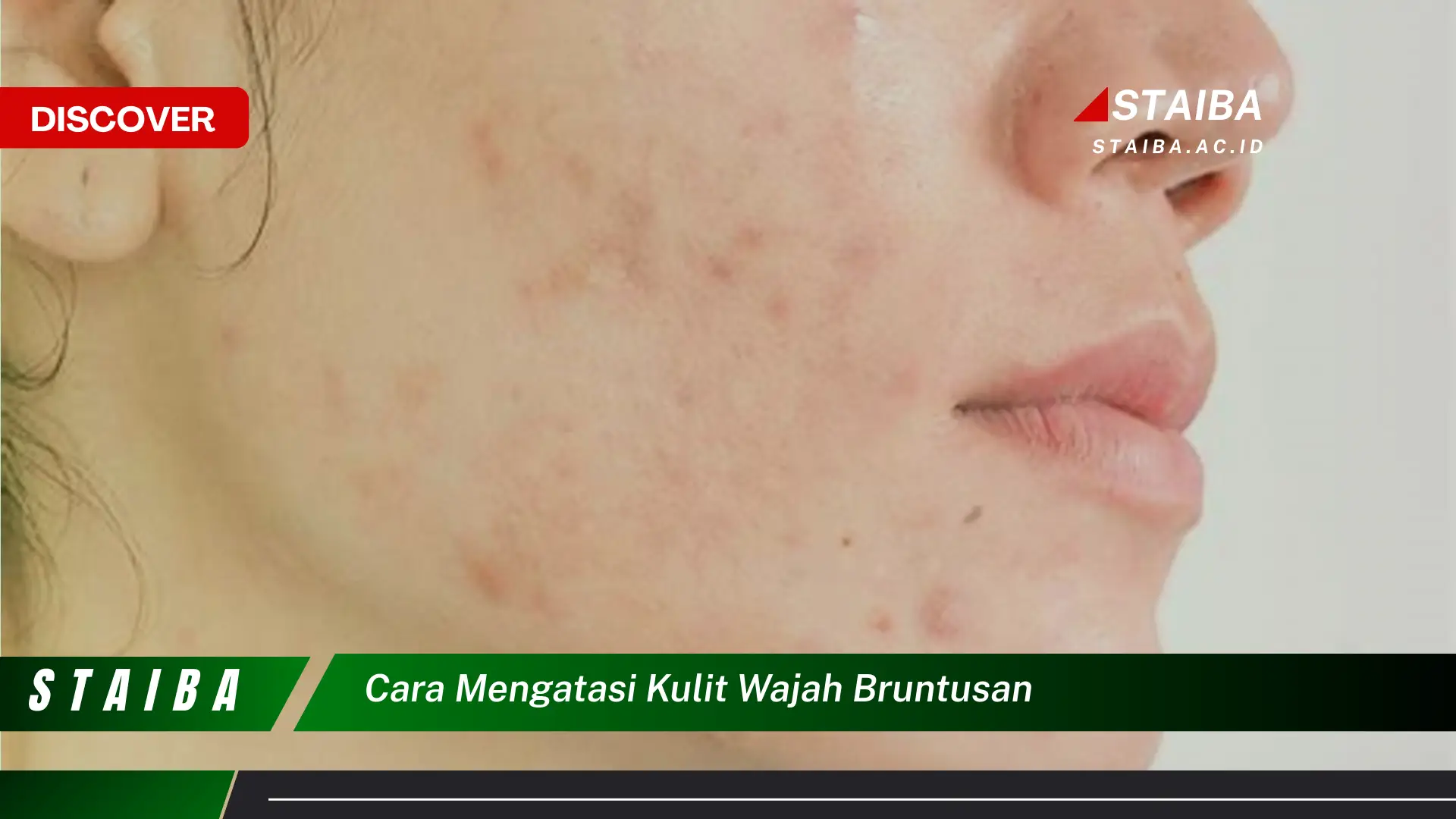 cara mengatasi kulit wajah bruntusan