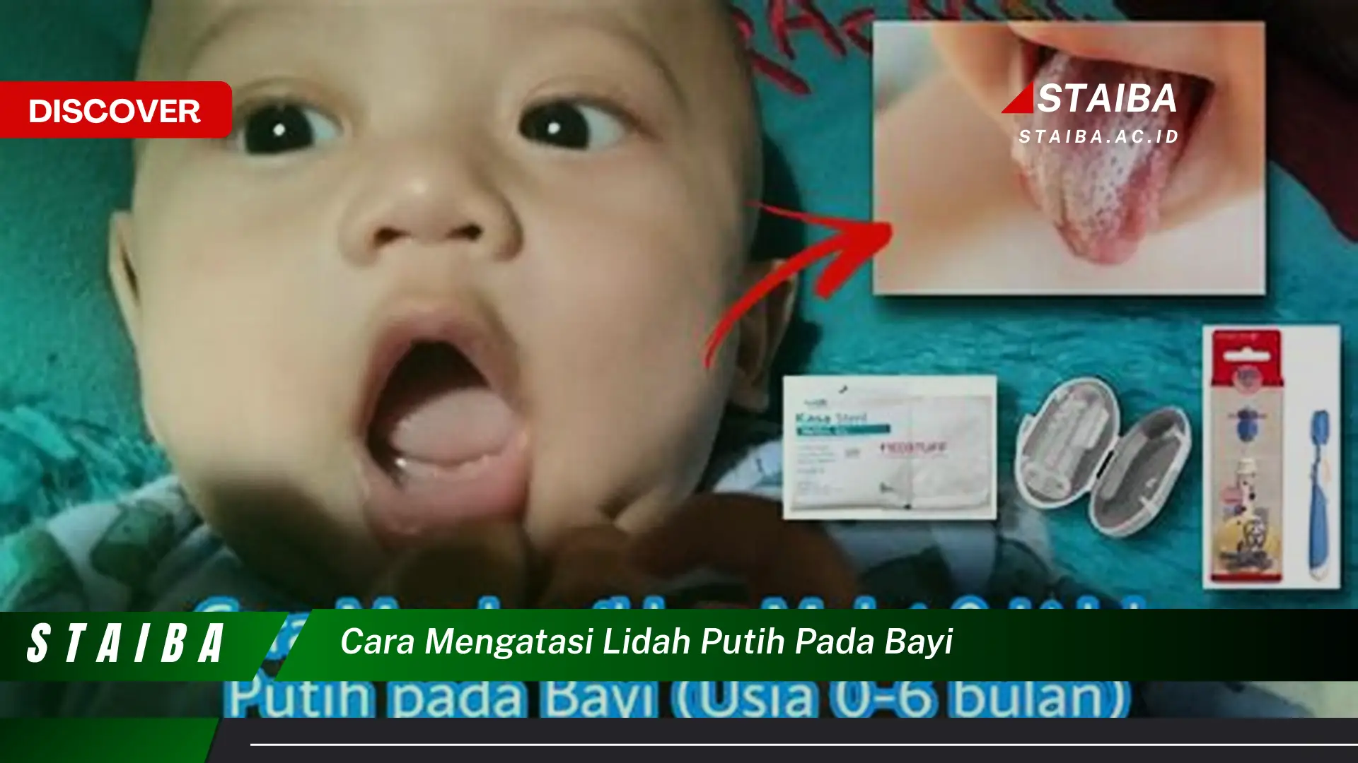 Temukan Cara Mengatasi Lidah Putih Pada Bayi yang Sudah Terbukti