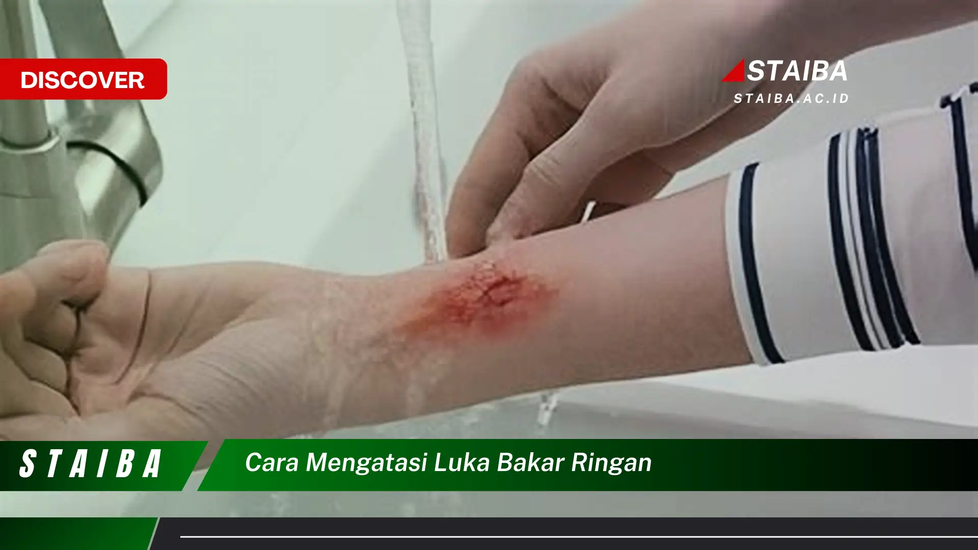 cara mengatasi luka bakar ringan