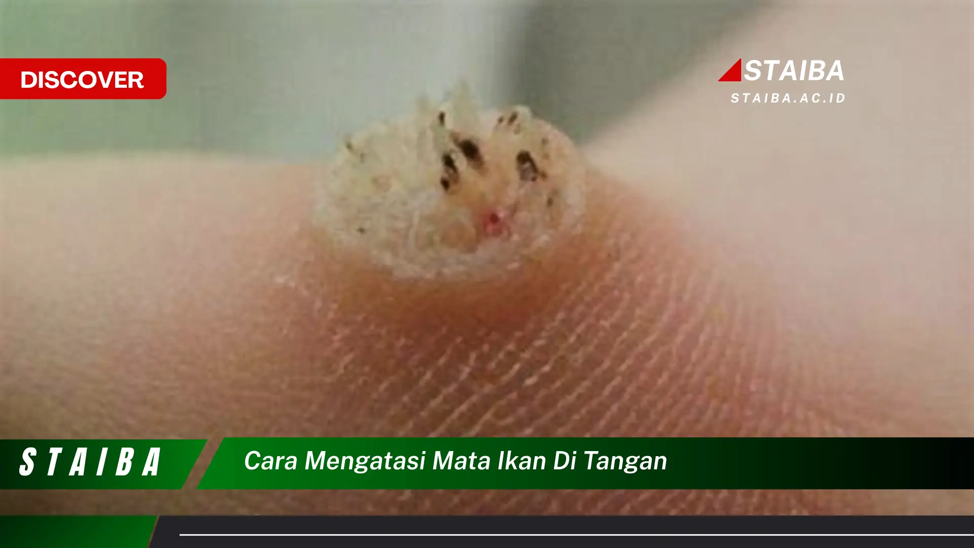 cara mengatasi mata ikan di tangan