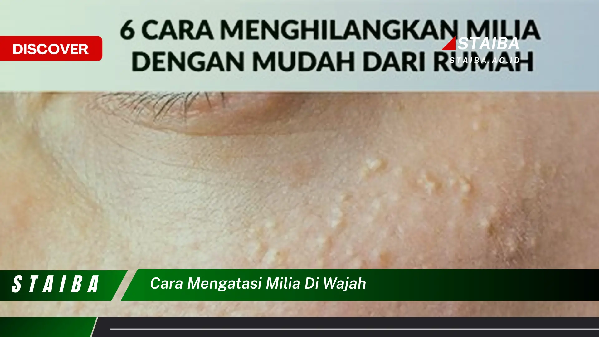 cara mengatasi milia di wajah