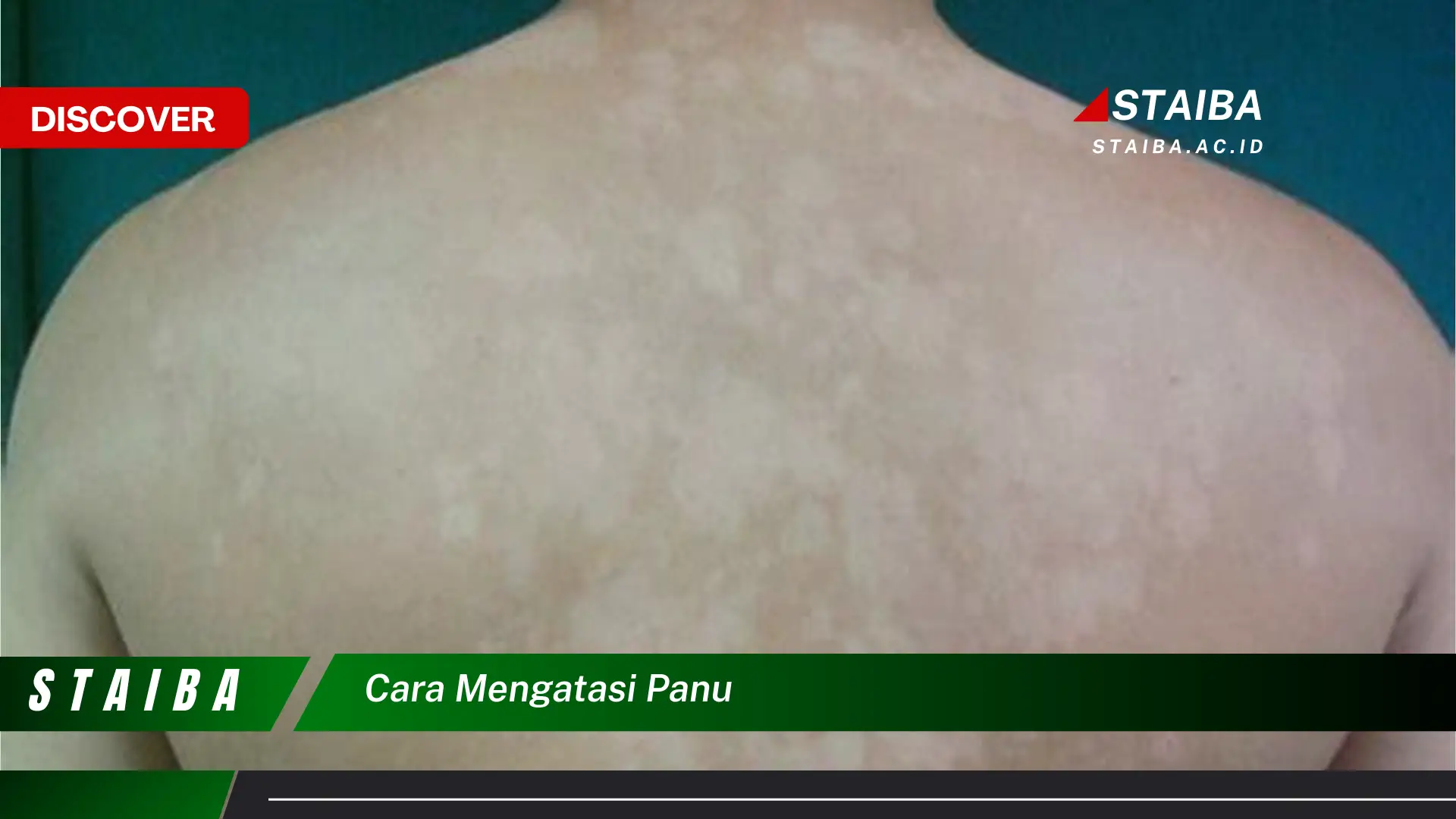 cara mengatasi panu cara mengatasi panu
