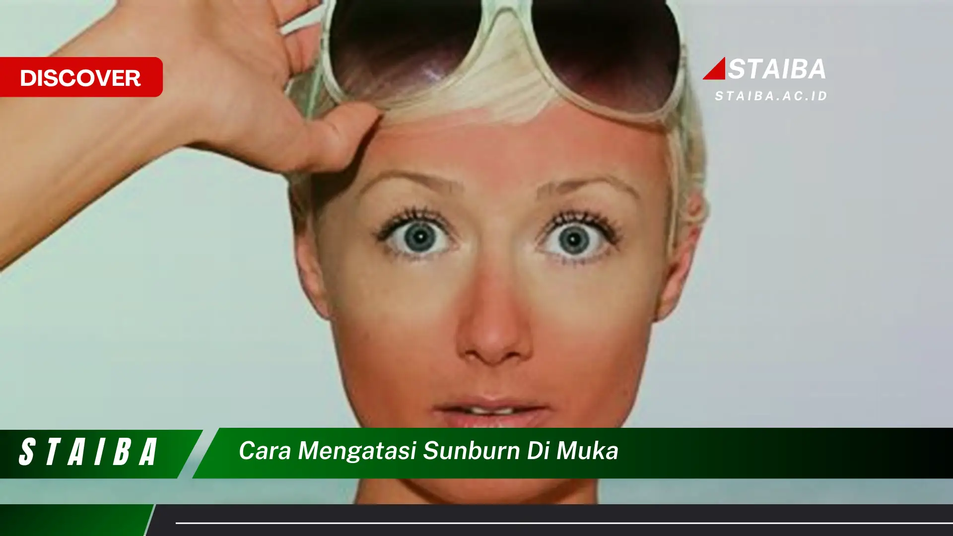 cara mengatasi sunburn di muka