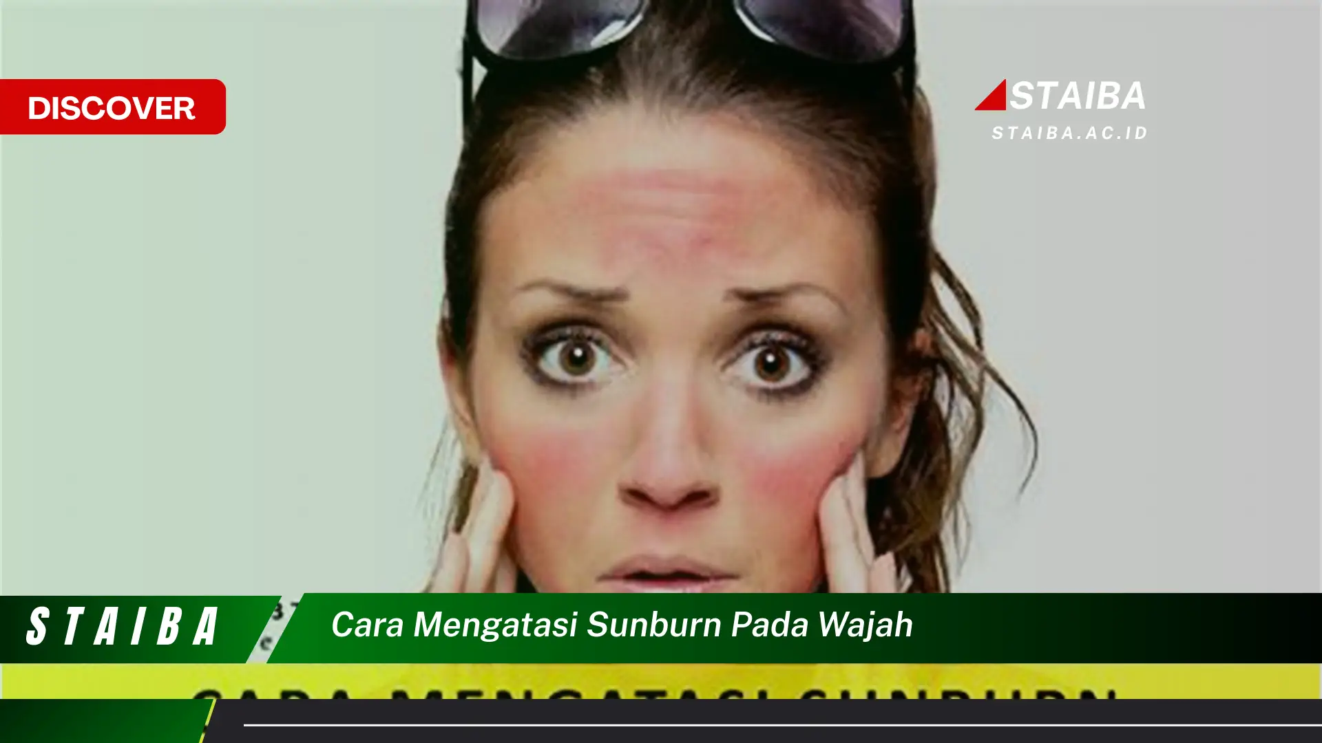 cara mengatasi sunburn pada wajah