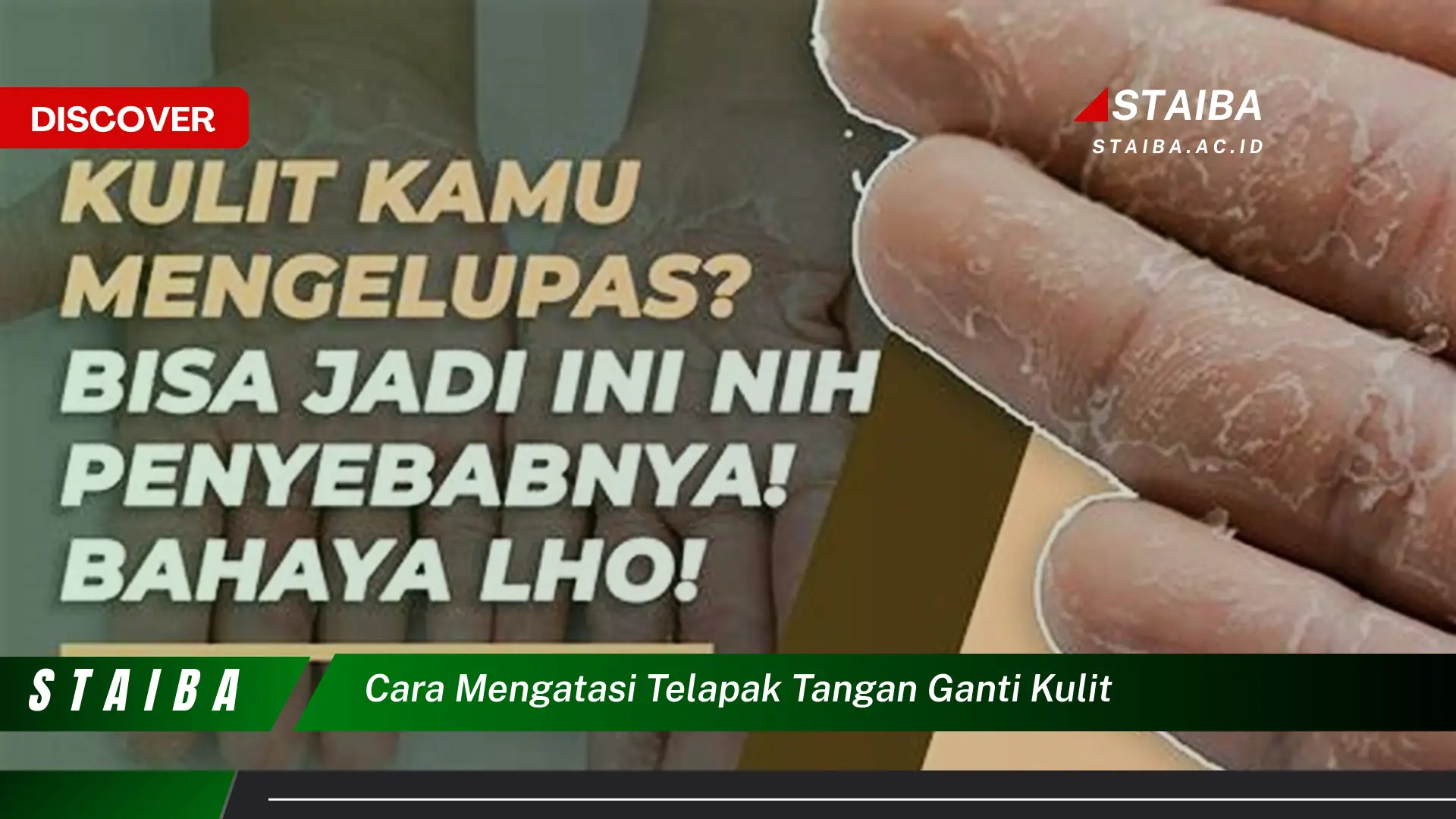 cara mengatasi telapak tangan ganti kulit