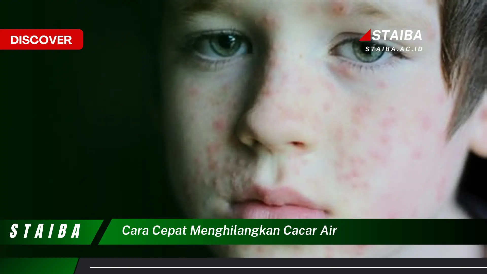 cara cepat menghilangkan cacar air