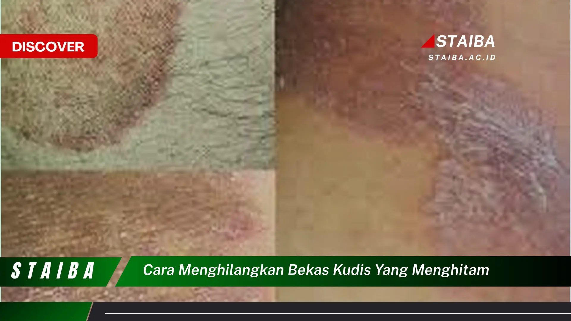 cara menghilangkan bekas kudis yang menghitam