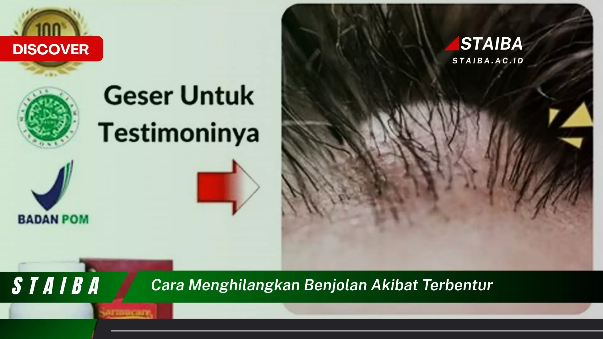 cara menghilangkan benjolan akibat terbentur