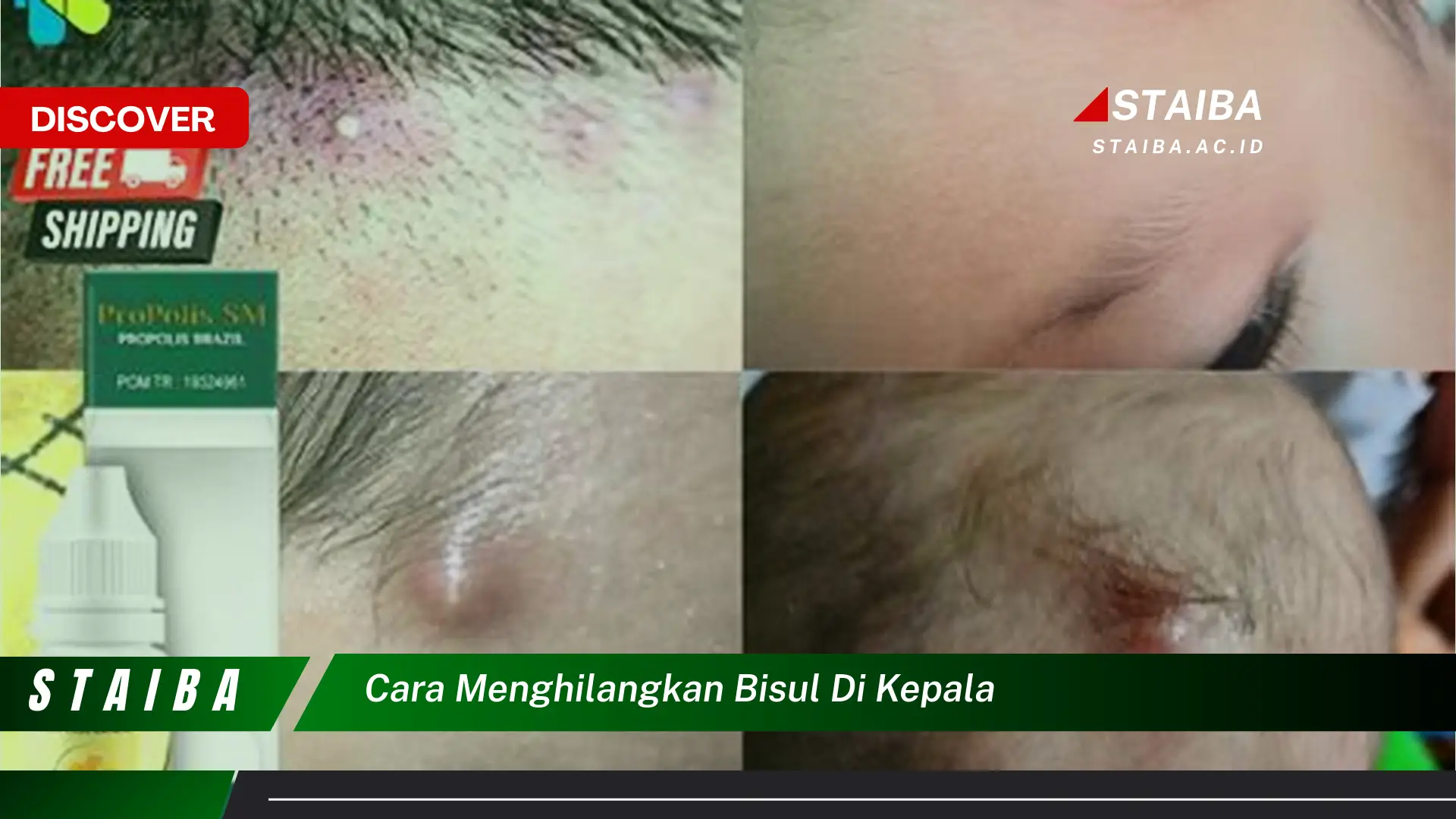 cara menghilangkan bisul di kepala cara menghilangkan bisul di kepala