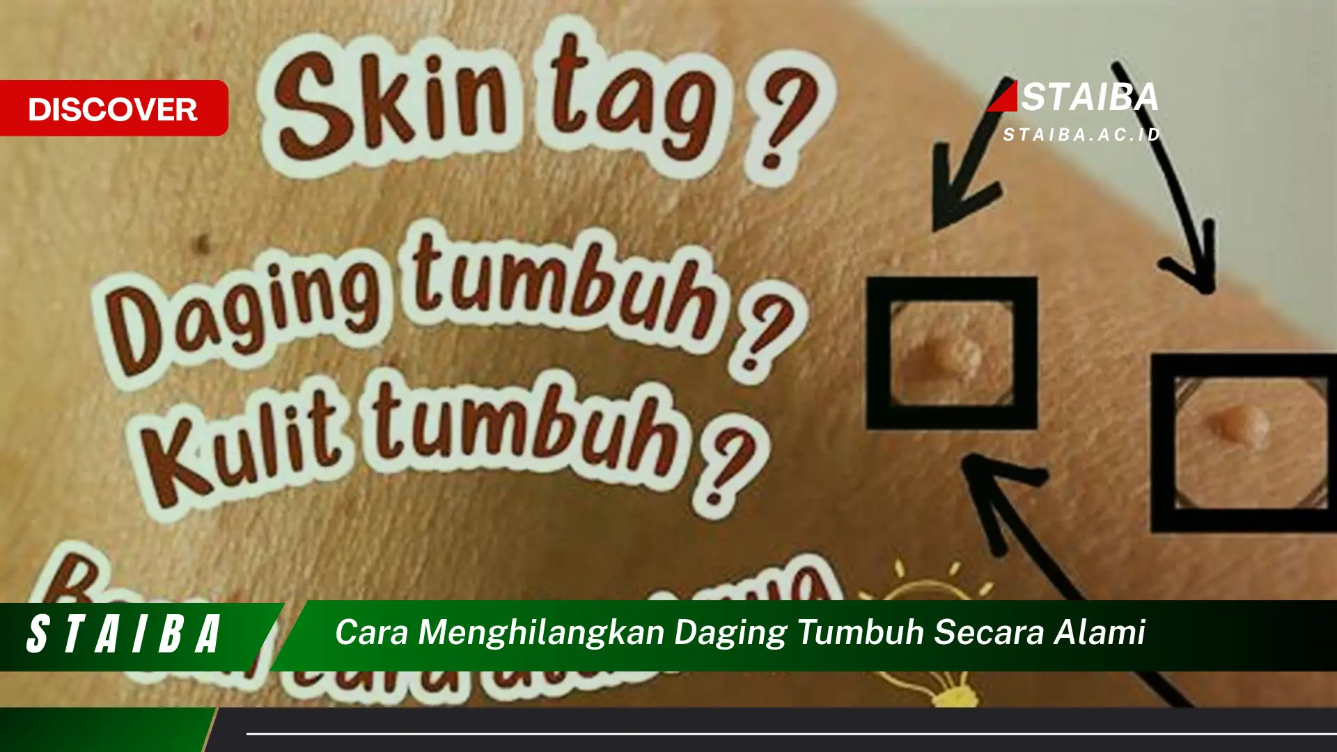 cara menghilangkan daging tumbuh secara alami