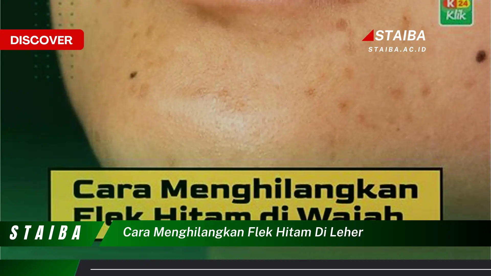 cara menghilangkan flek hitam di leher