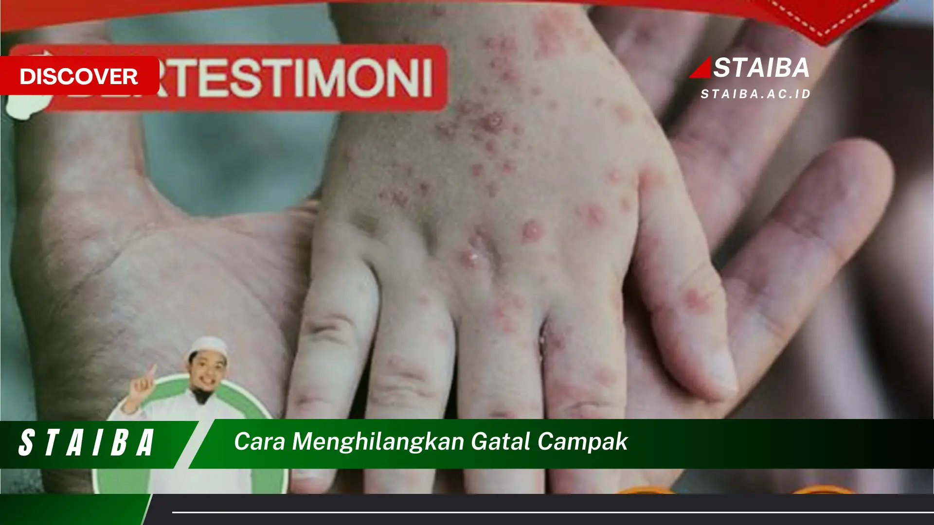 cara menghilangkan gatal campak