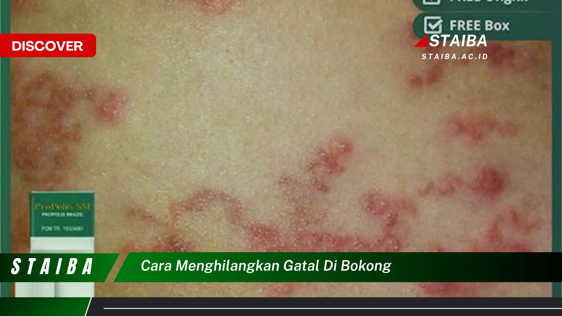 cara menghilangkan gatal di bokong