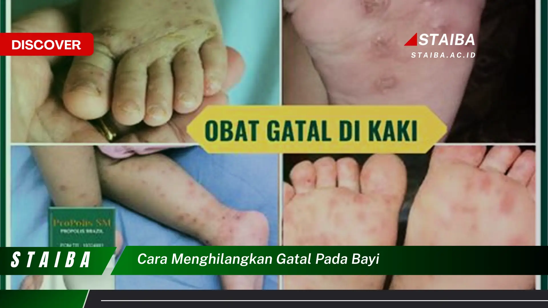 Temukan Cara Baru Hilangkan Gatal pada Bayi yang Mudah Dipahami