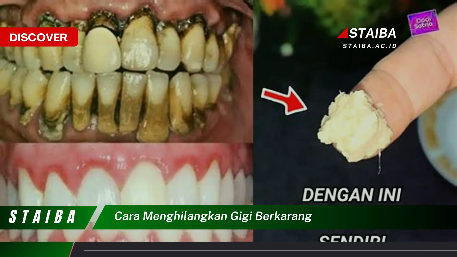 cara menghilangkan gigi berkarang