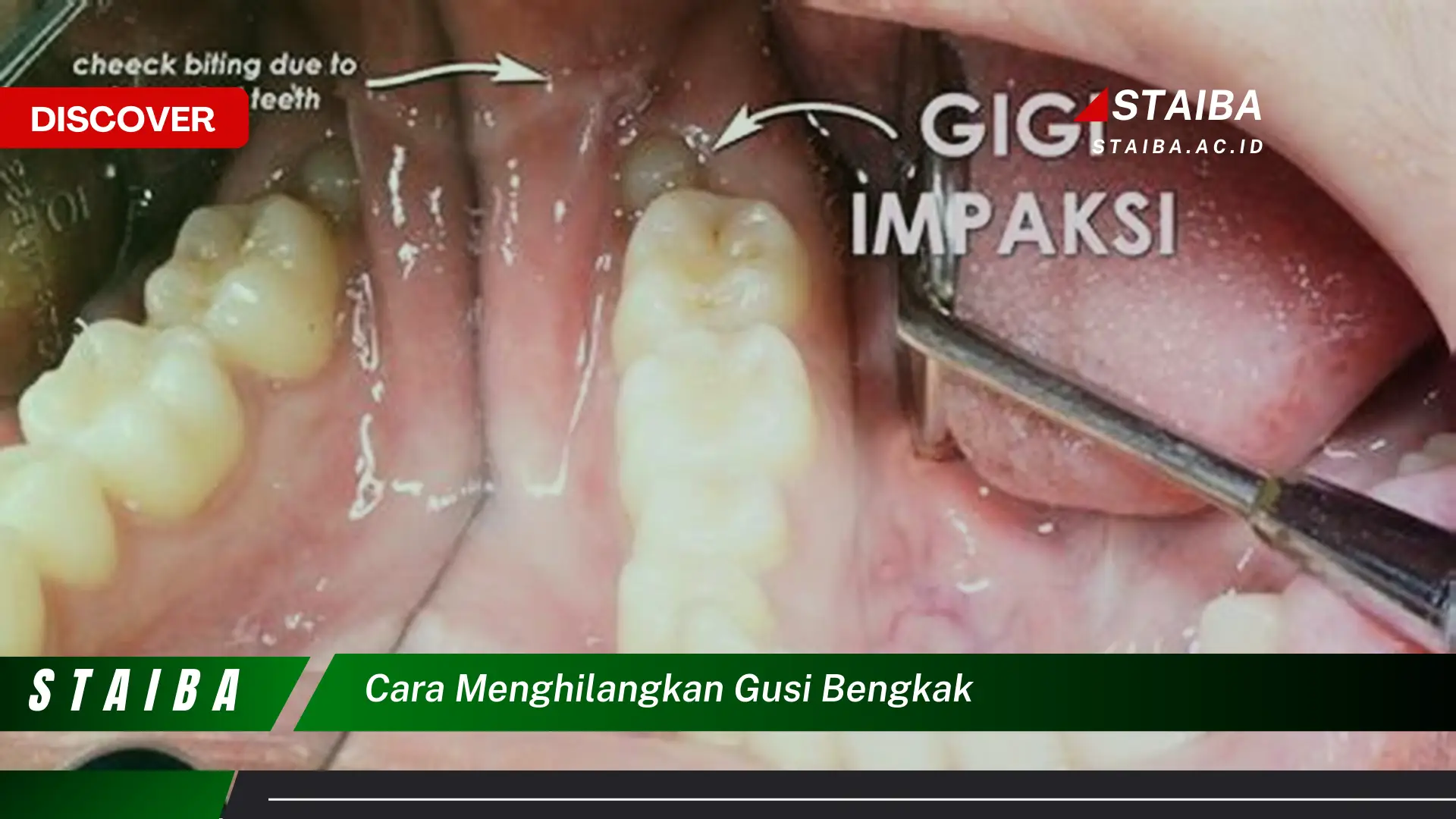 cara menghilangkan gusi bengkak