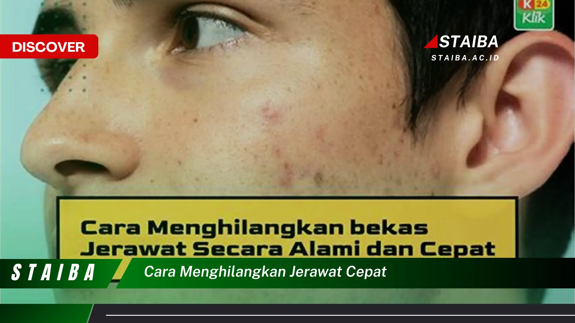 cara menghilangkan jerawat cepat