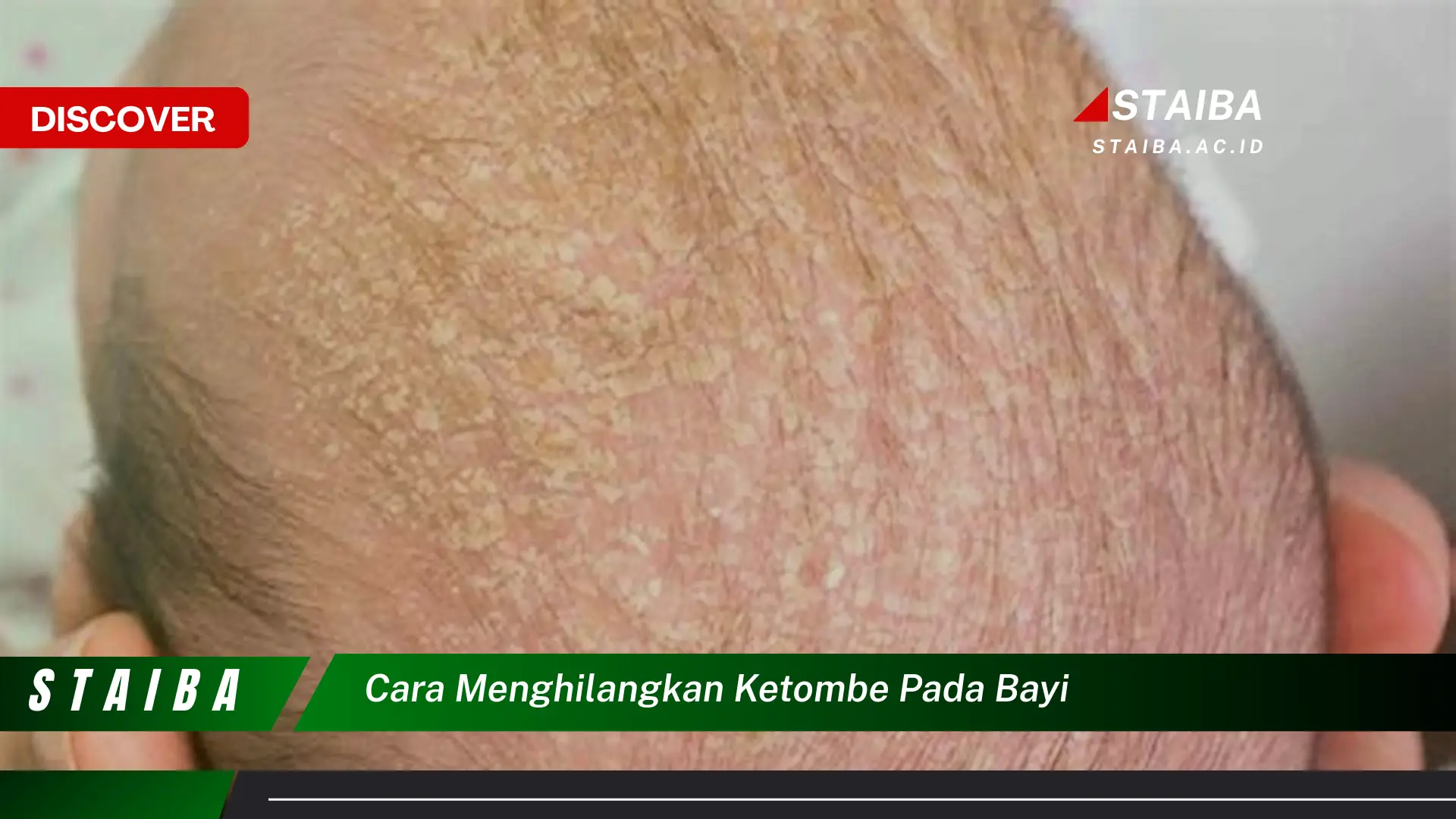 cara menghilangkan ketombe pada bayi cara menghilangkan ketombe pada bayi