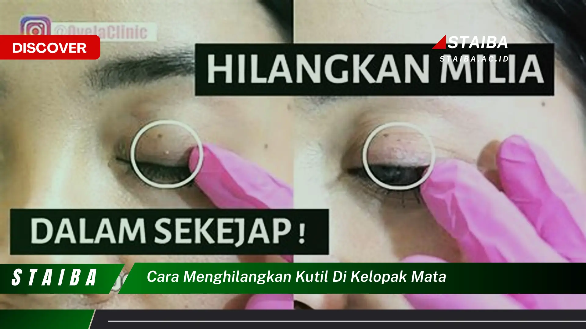 cara menghilangkan kutil di kelopak mata