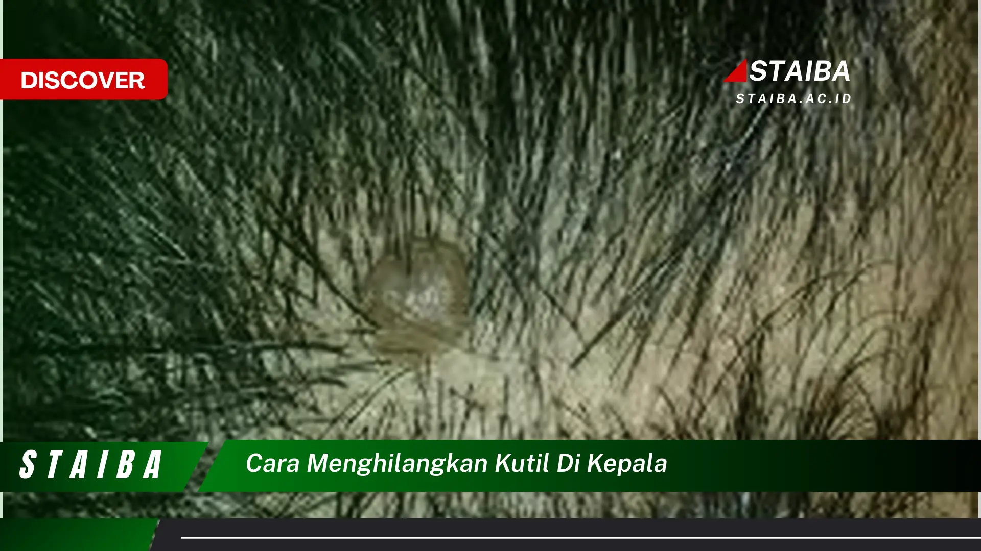 cara menghilangkan kutil di kepala