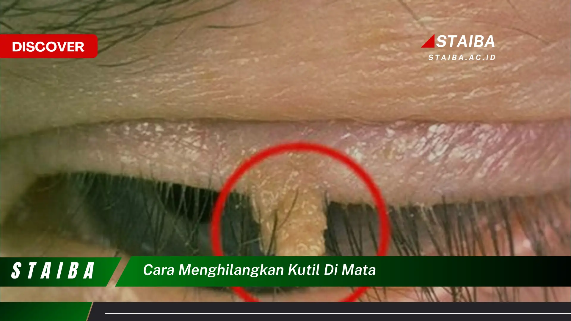 cara menghilangkan kutil di mata