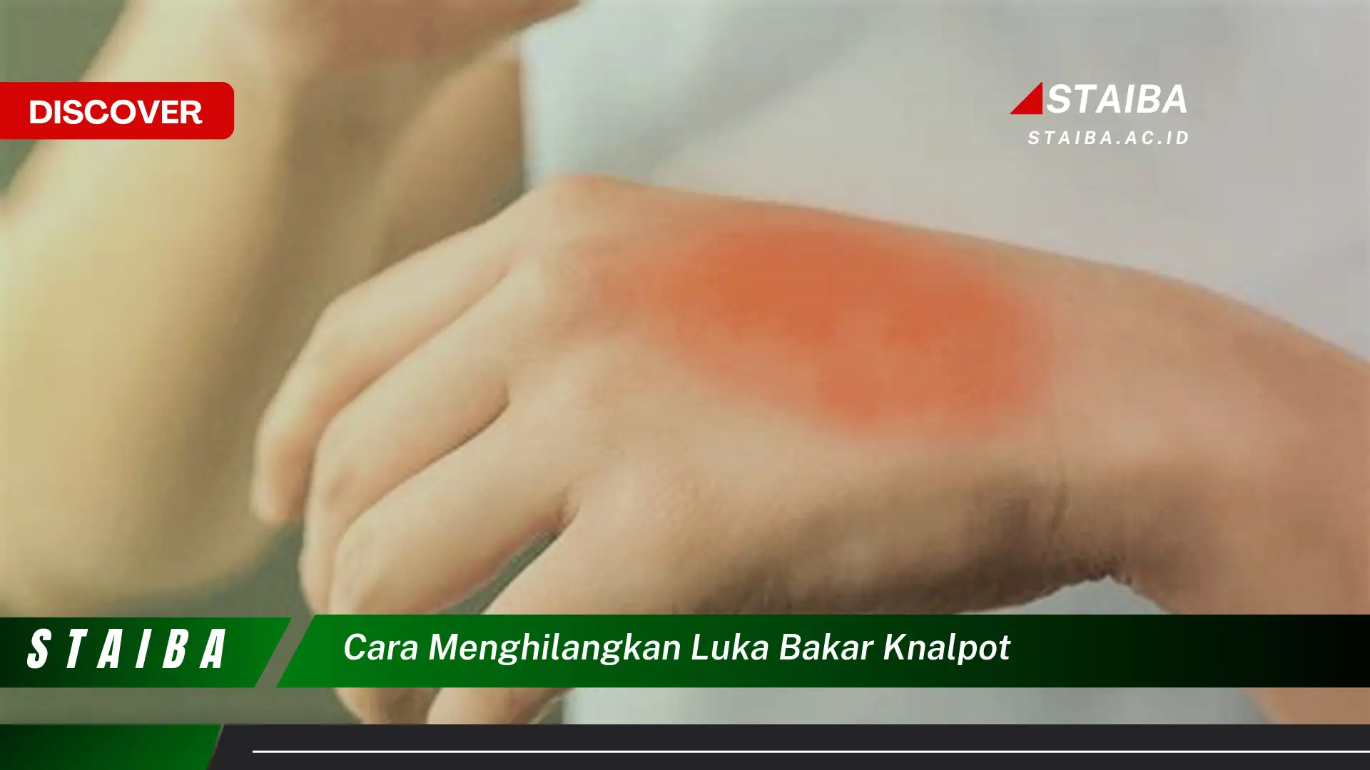 cara menghilangkan luka bakar knalpot