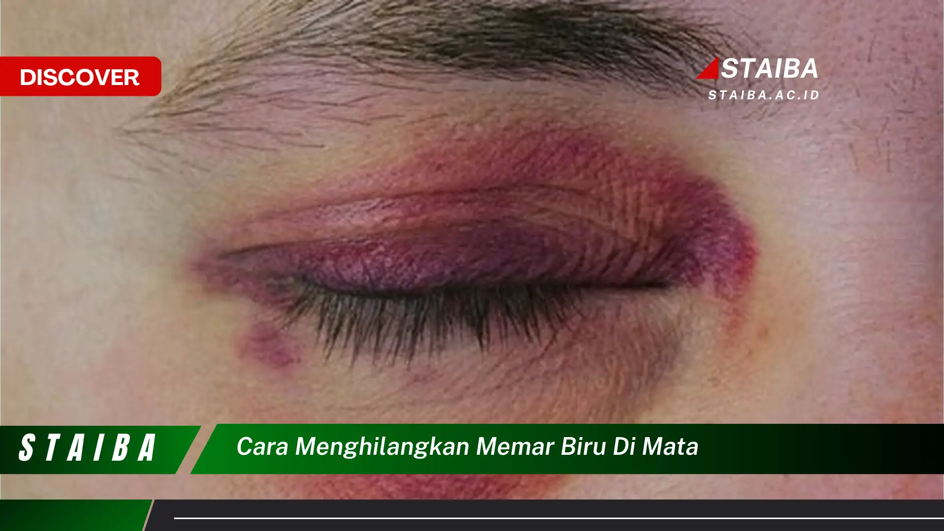 cara menghilangkan memar biru di mata