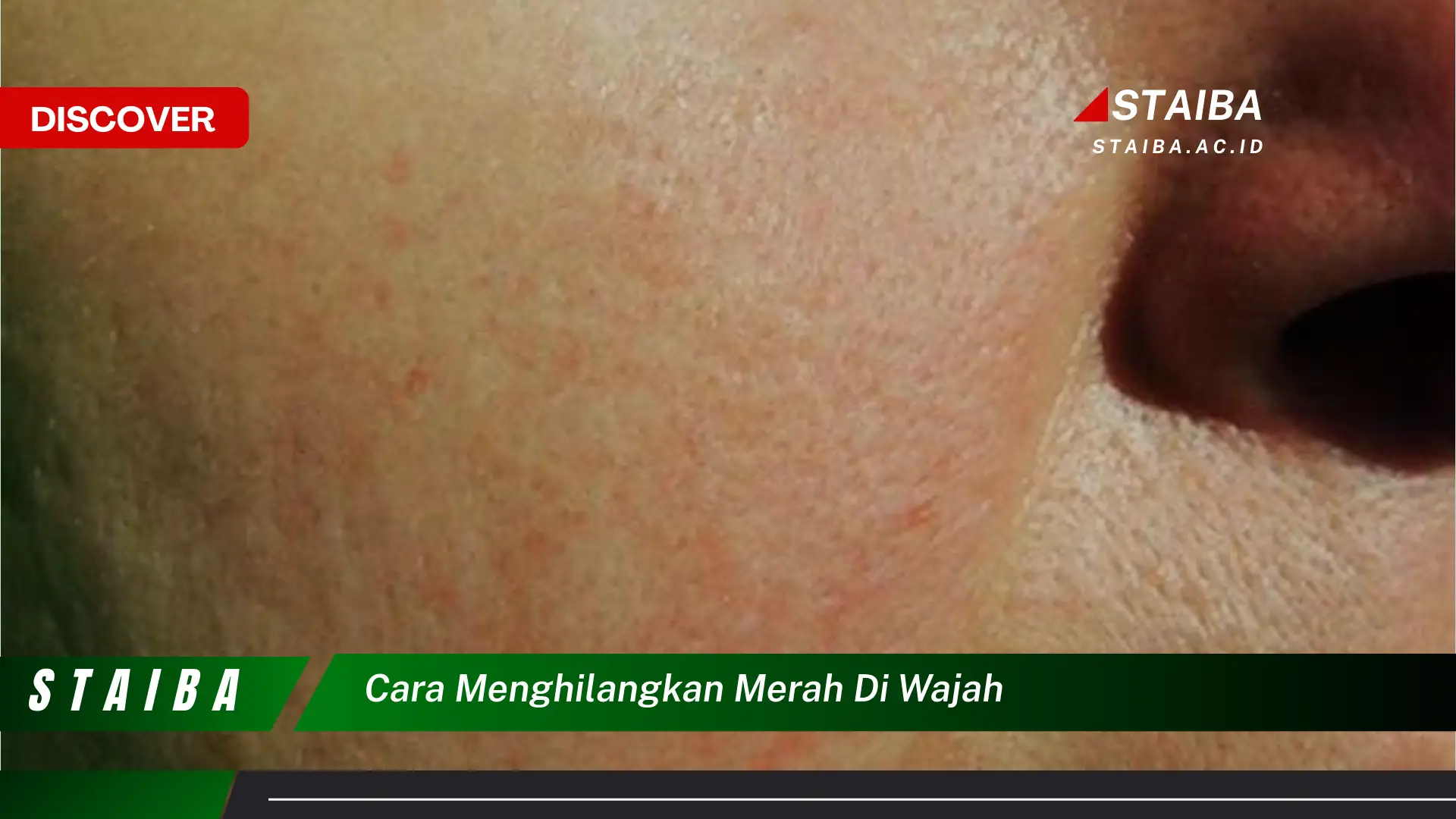 cara menghilangkan merah di wajah