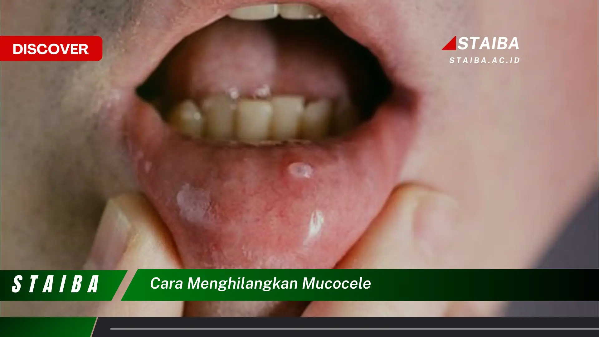 cara menghilangkan mucocele