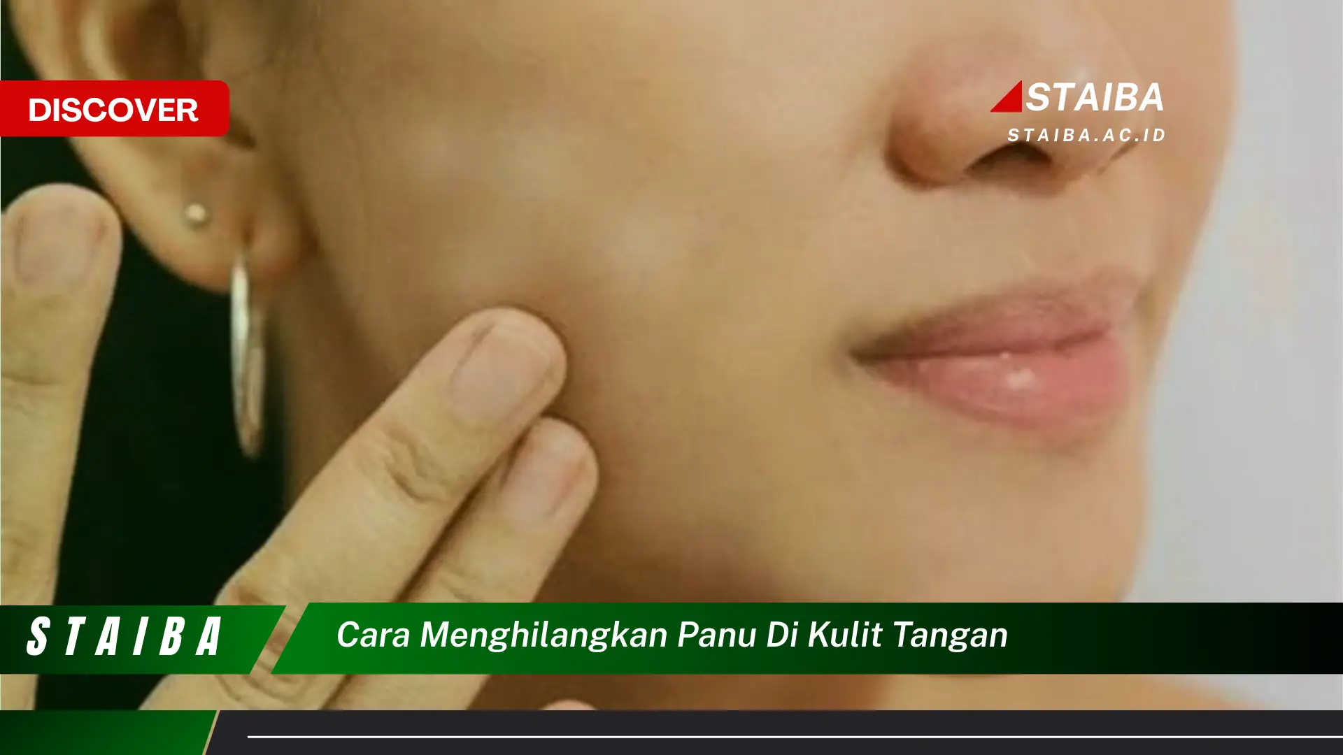 cara menghilangkan panu di kulit tangan