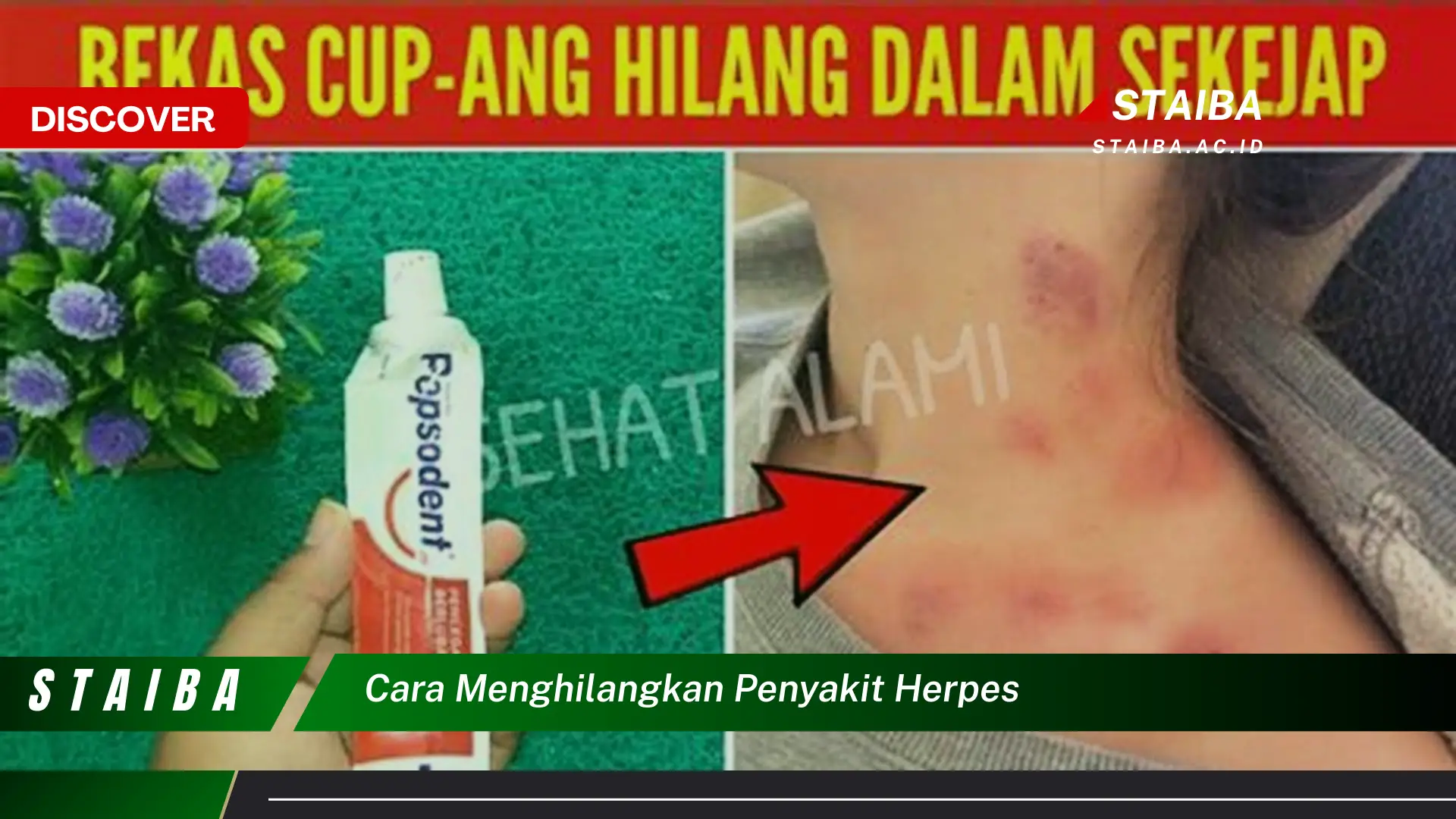 cara menghilangkan penyakit herpes