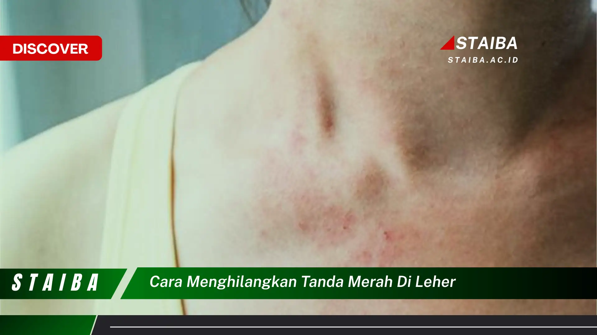 Temukan Cara Cerdas Menghilangkan Tanda Merah di Leher yang Jarang Diketahui!