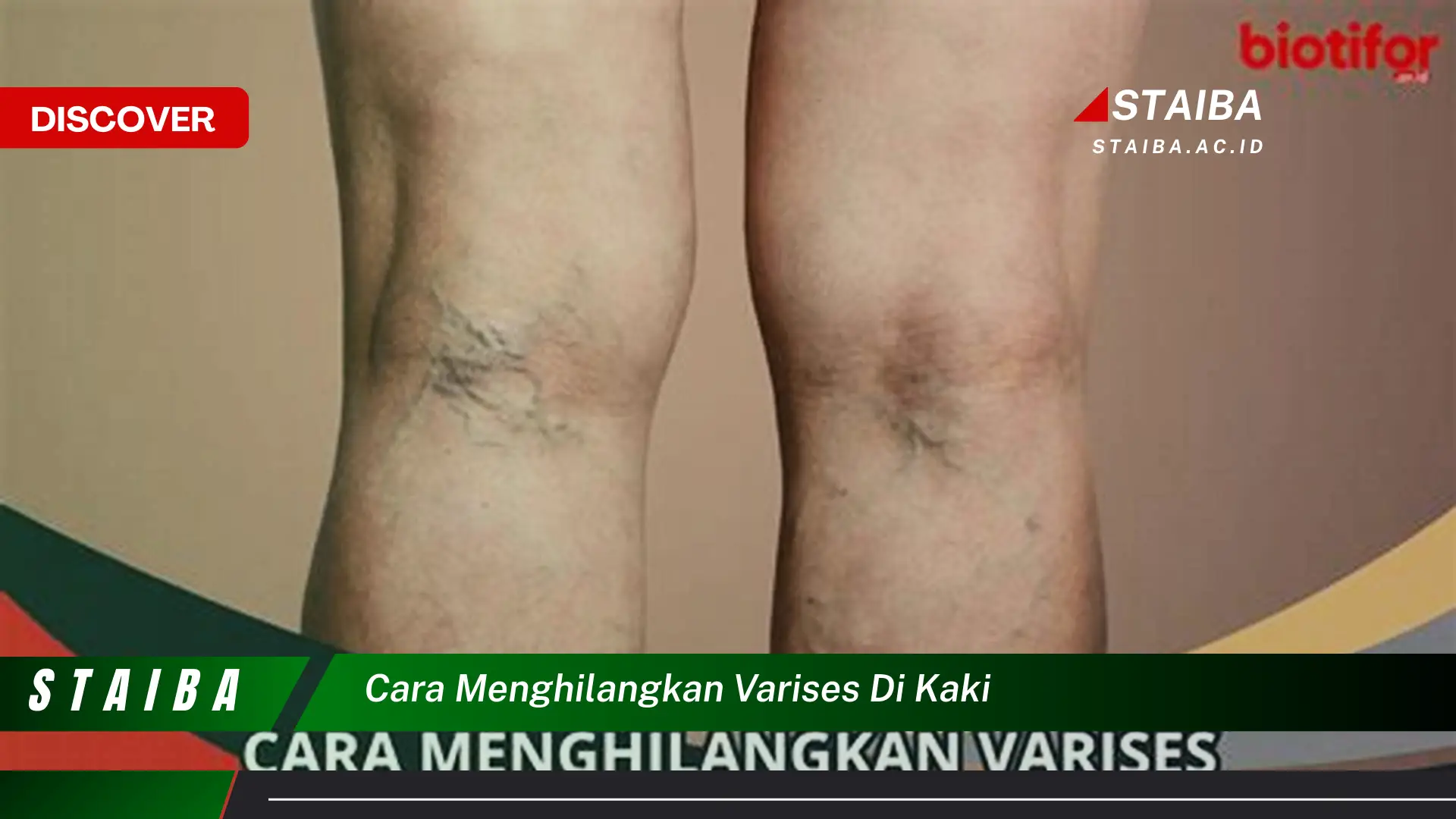 cara menghilangkan varises di kaki cara menghilangkan varises di kaki